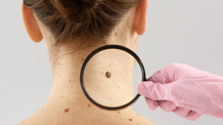 dermatoloji-uzmani-acikladi-benlerdeki-degisiklikleri-hafife-almayin-RKeriGEu
